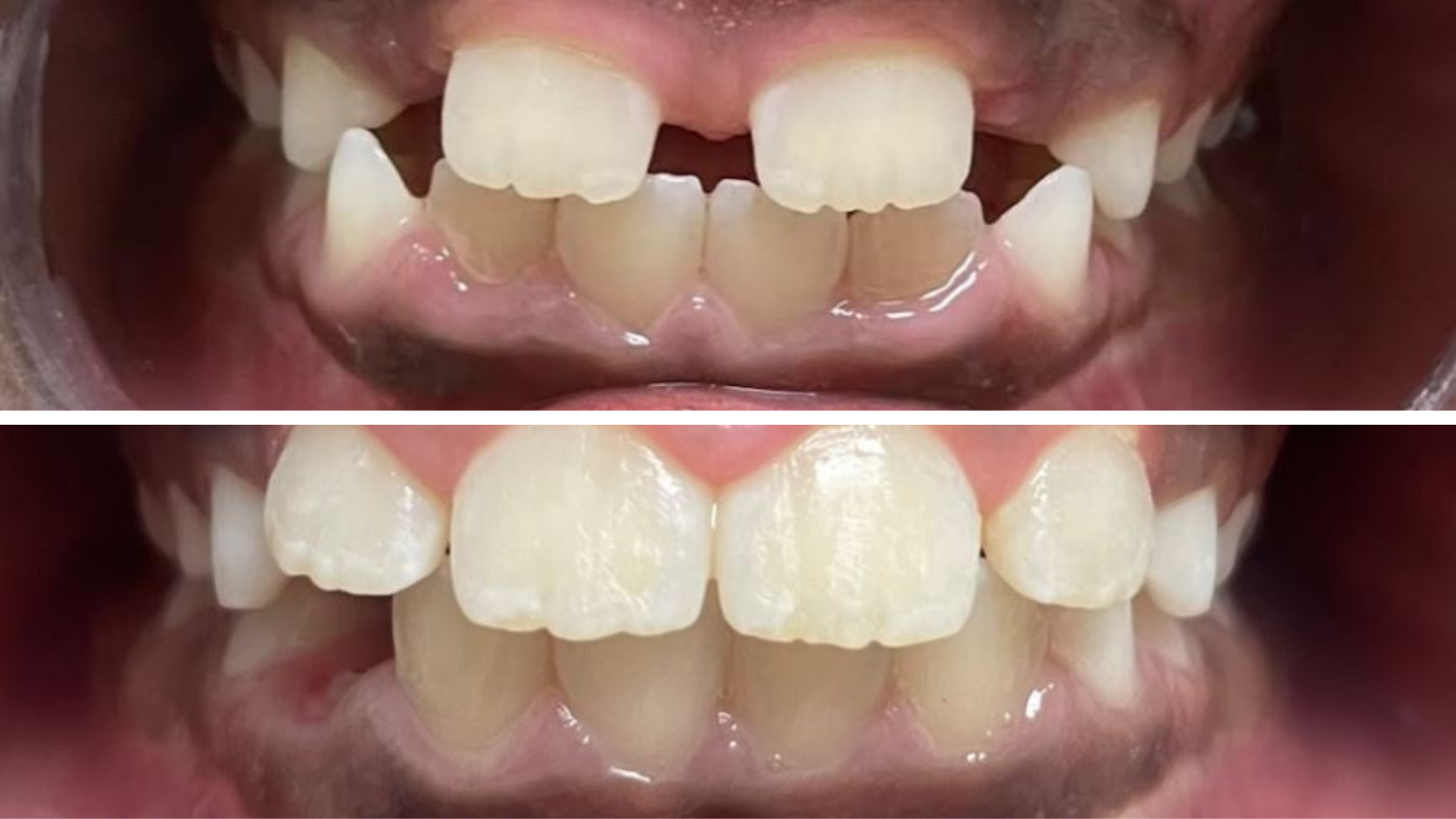 Braces & Orthodontics 6 Before