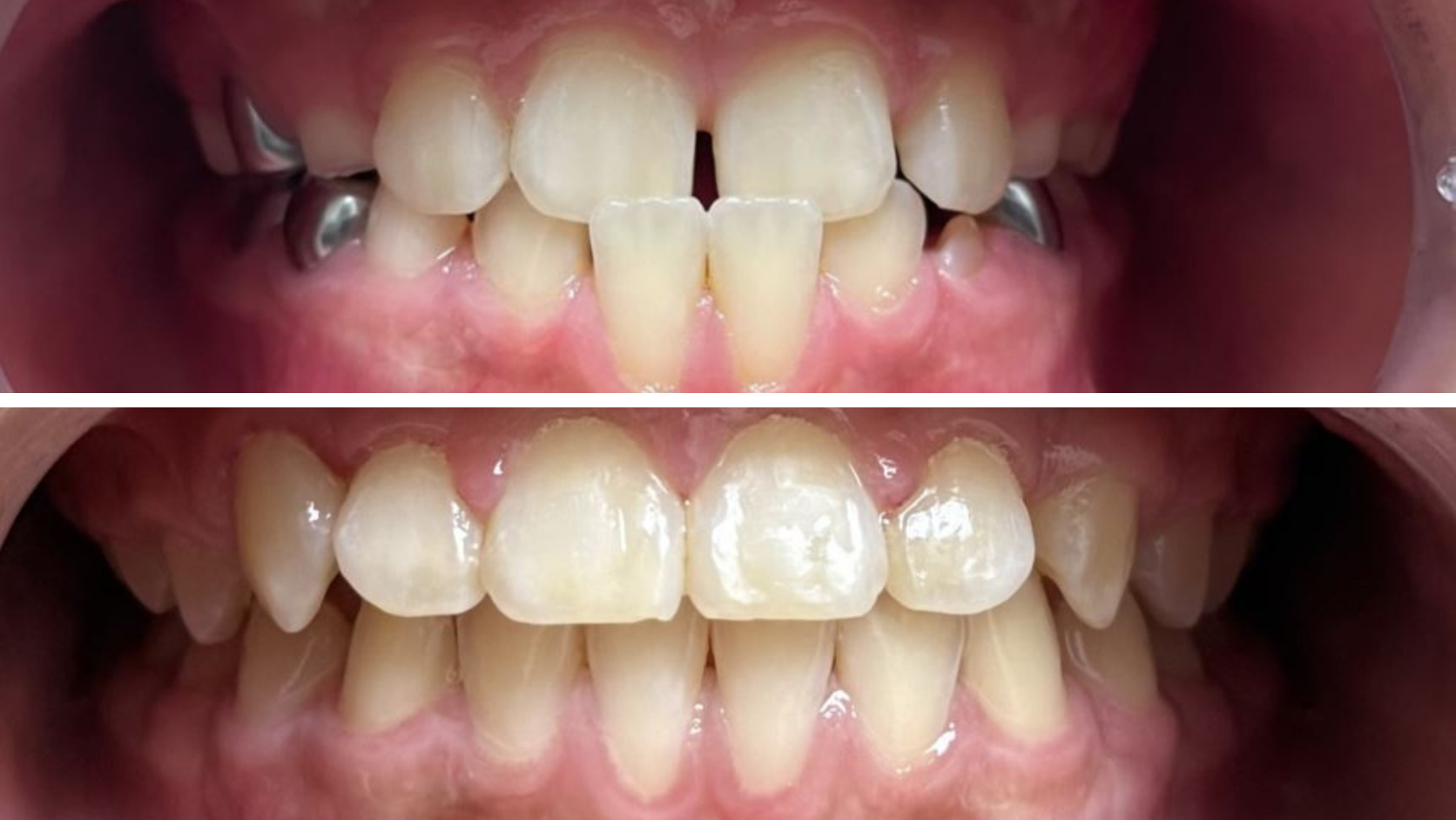Braces & Orthodontics 15 Before