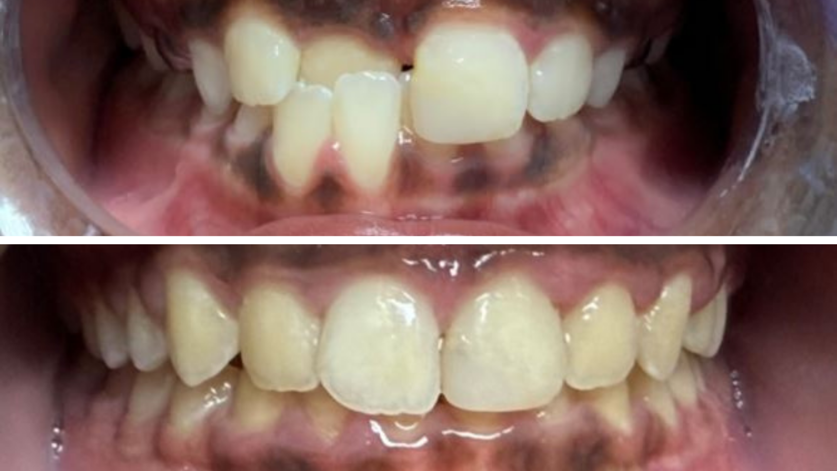 Braces & Orthodontics 9 Before