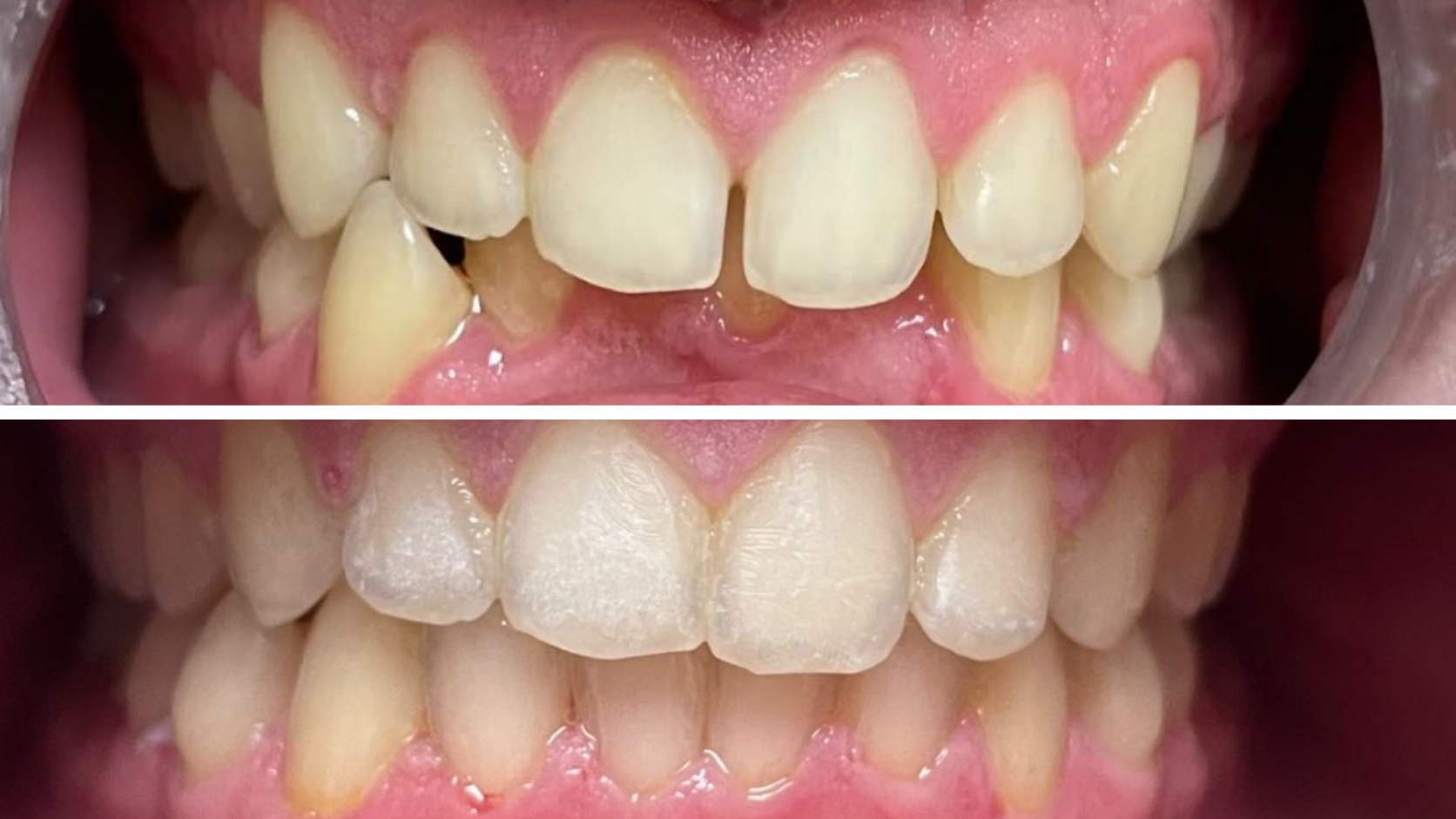 Braces & Orthodontics 12 Before