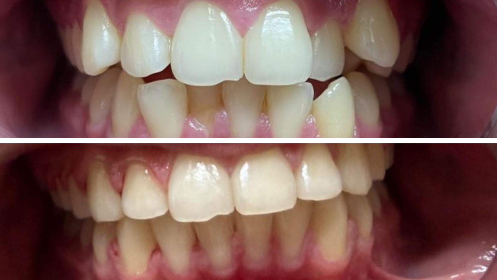 Braces & Orthodontics 21 Before