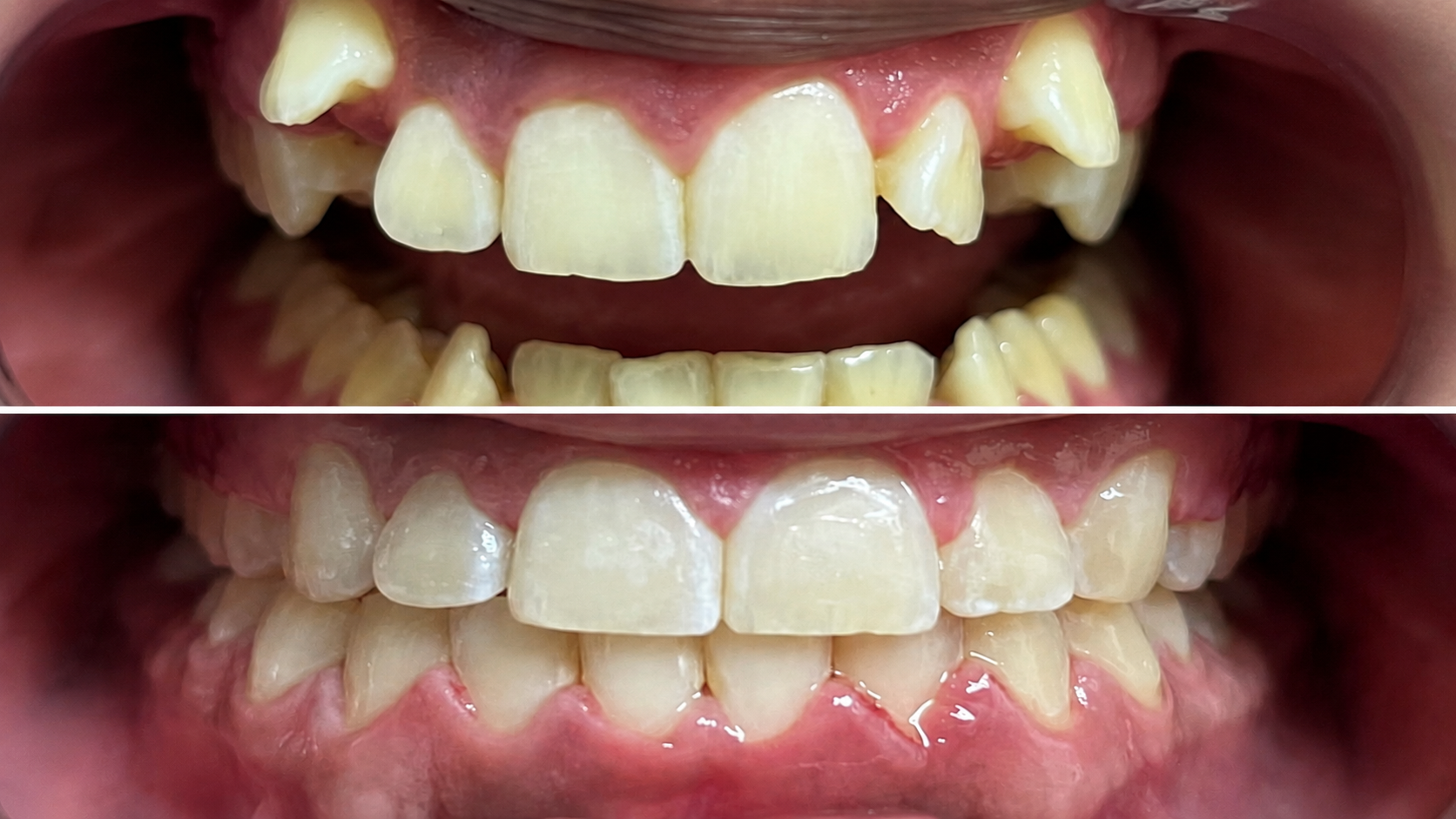 Braces & Orthodontics 18 Before