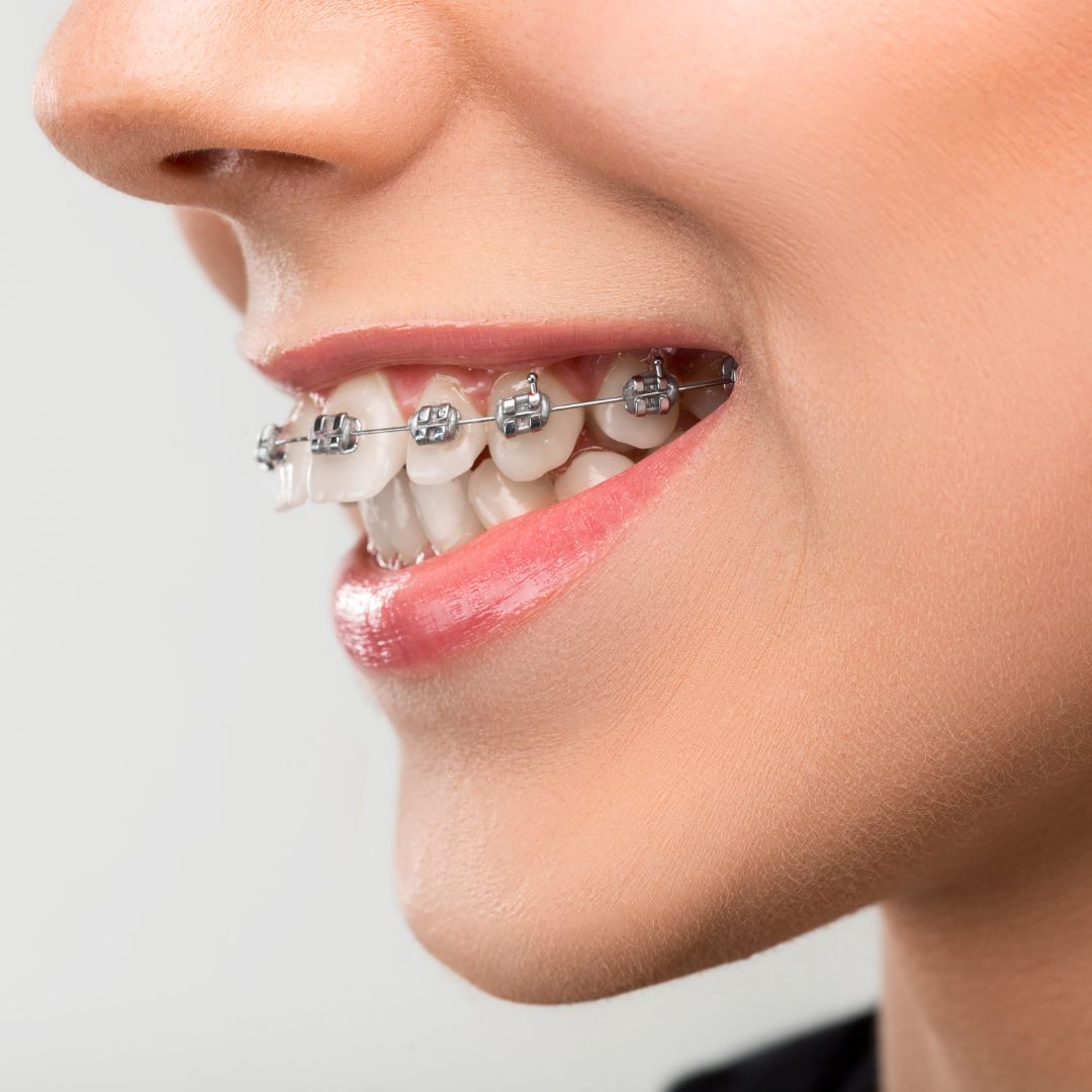 Braces & Orthodontics 2
