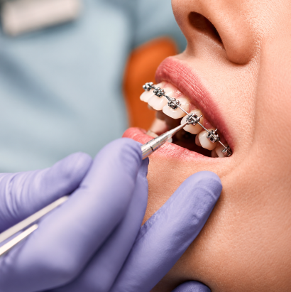 braces dot dental 1